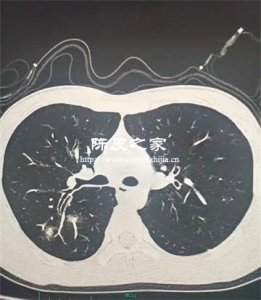 陈皮可以用来预防支原体肺炎吗