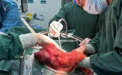 直肠癌手术后可以喝陈皮水吗